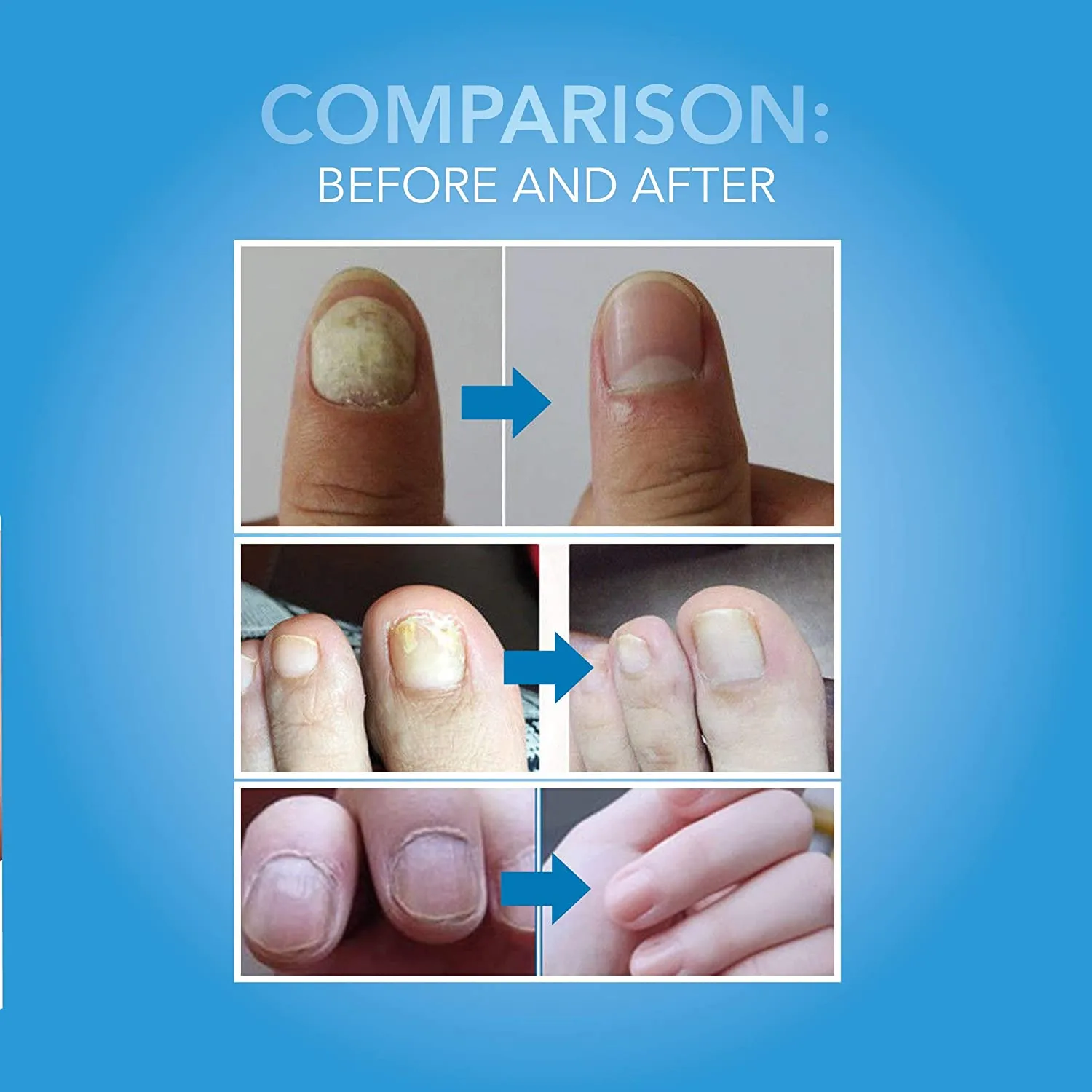 Arishine Fungus Treatment, Fungus Stop, Anti Fungus Nail Treatment, Effective Against Nail Fungus, Anti Fungal Nail Solution, Toenails and Fingernails Solution (2 Pack)