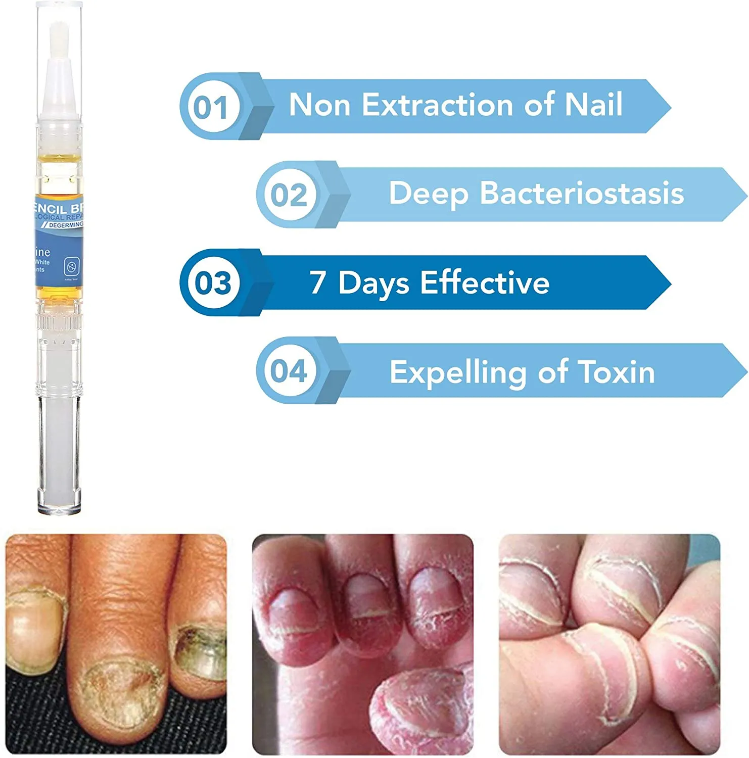 Arishine Fungus Treatment, Fungus Stop, Anti Fungus Nail Treatment, Effective Against Nail Fungus, Anti Fungal Nail Solution, Toenails and Fingernails Solution (2 Pack)